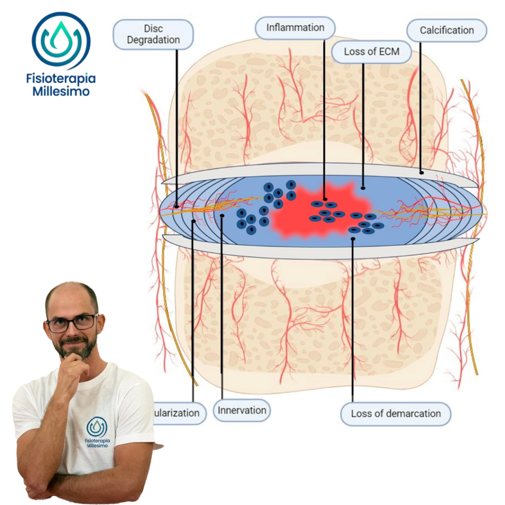 ernia del disco, lombalgia, mal di schiena, sciatica