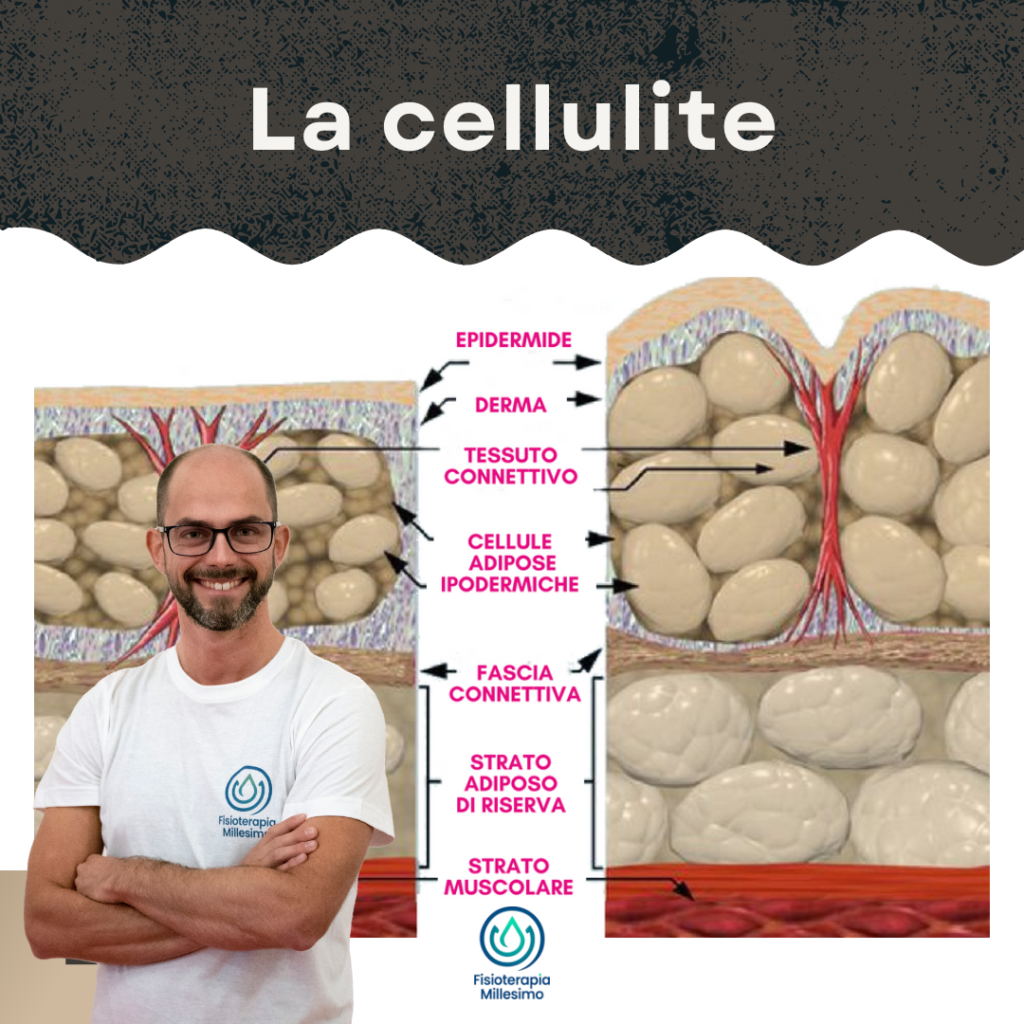 Cellulite e dolore